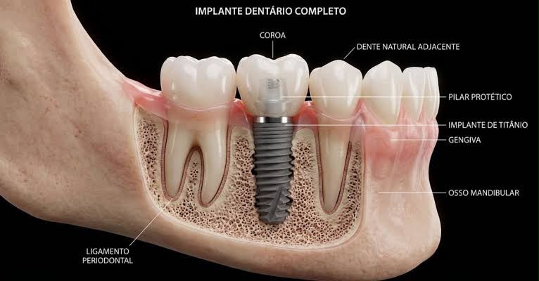 Resultado de Implantes Dentários